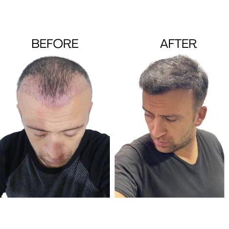 Hair Transplant Before-After-2