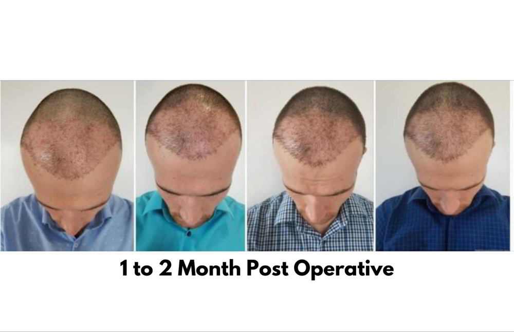 Hair Transplant Before-After-3