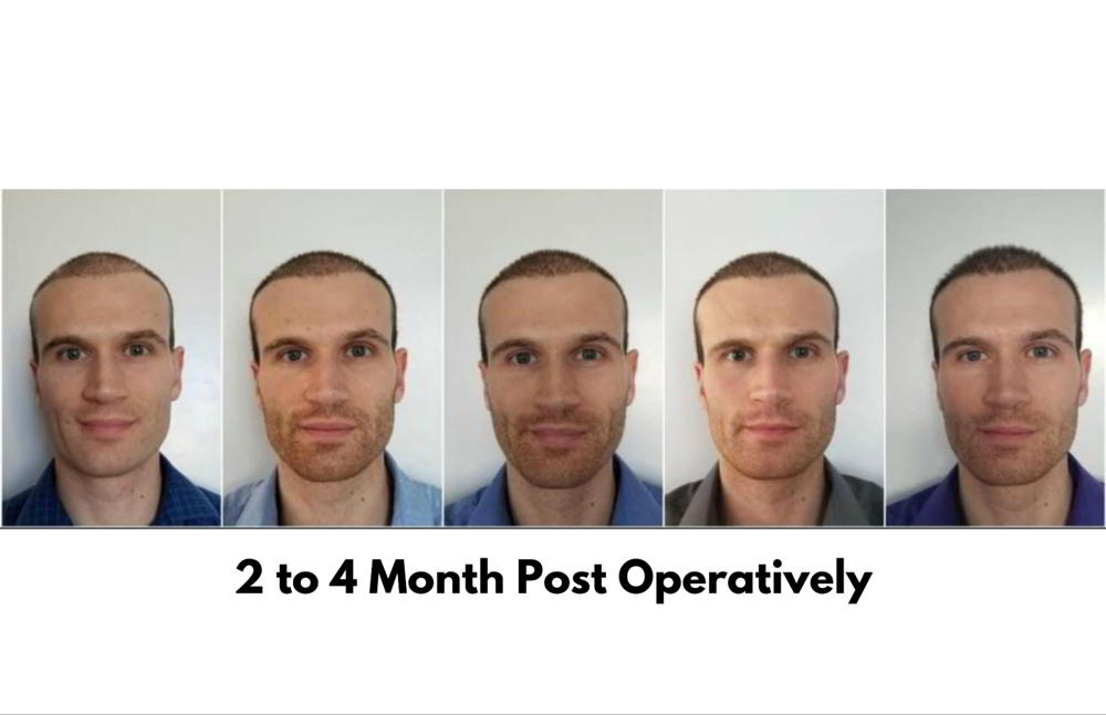Hair Transplant Before-After-4