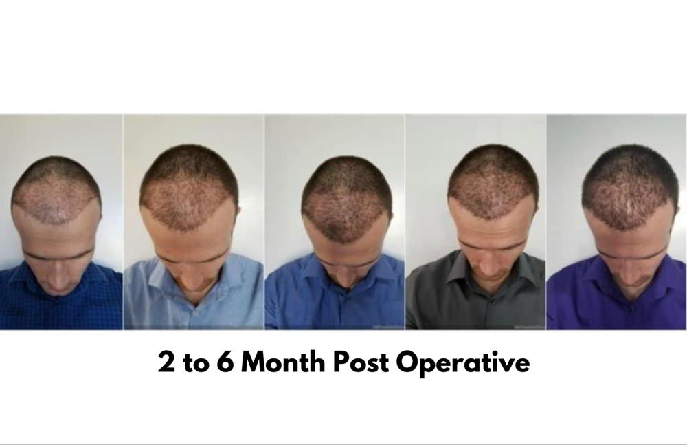 Hair Transplant Before-After-5