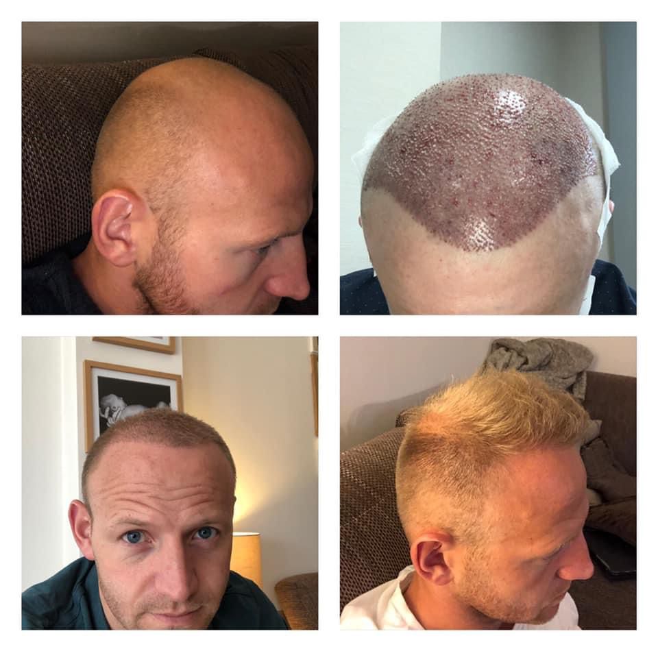 Hair Transplant Before-After-7