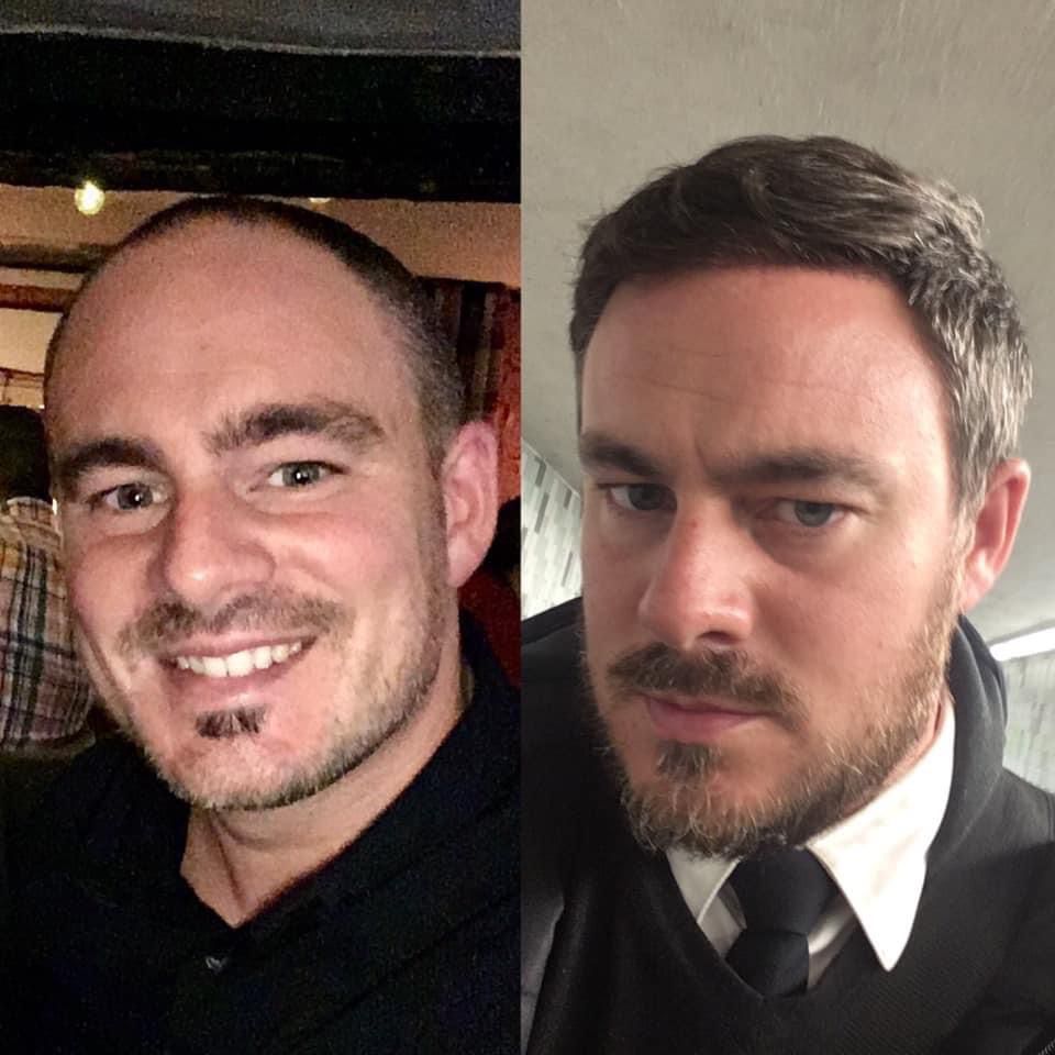 Hair Transplant Before-After-8