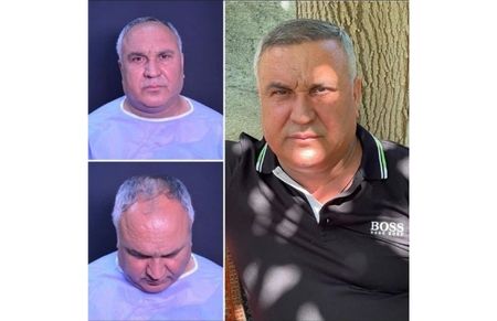 Hair Transplant Before-After-9